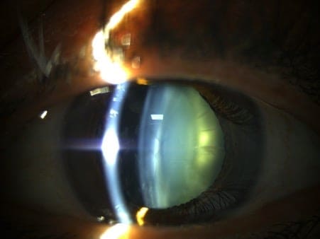 cataracte cortico nucleaire operation definition chirurgien ophtalmologue paupieres paris docteur florence pouget theron paris