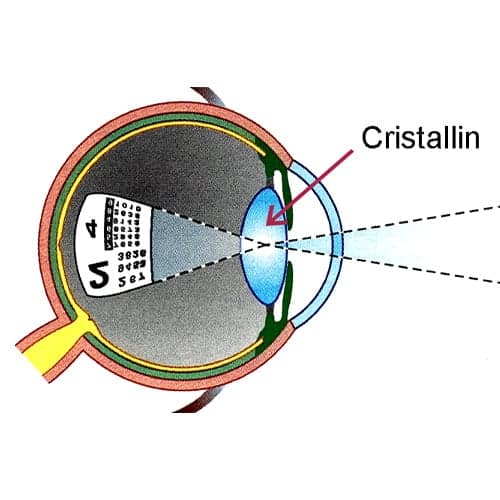 cristallin oeil definition cataracte chirurgien ophtalmologue paupieres paris docteur florence pouget theron paris