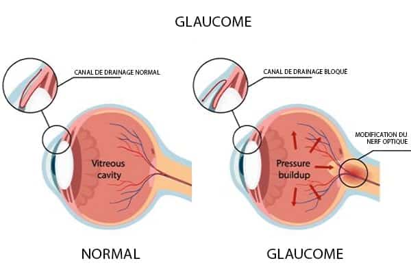 glaucome definition cause quand s inquieter tension oeil chirurgien ophtalmologue paupieres paris docteur florence pouget theron paris