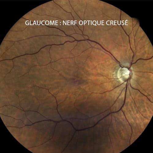 nerf optique creuse excave glaucome oculaire chirurgien ophtalmologue paupieres paris docteur florence pouget theron paris