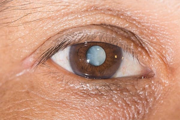 symptome cataracte oeil chirurgie chirurgien ophtalmologue paupieres paris docteur florence pouget theron paris