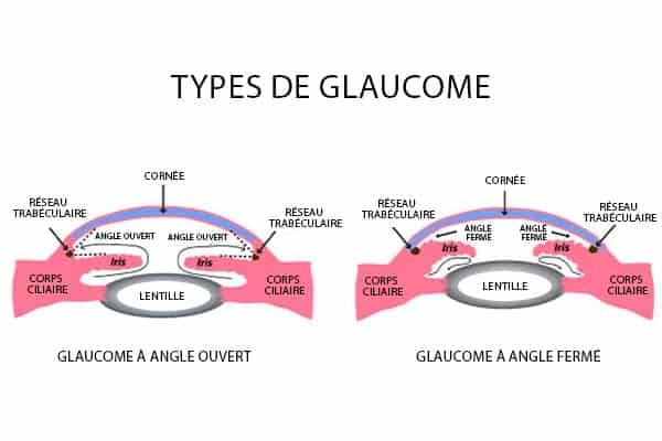 symptomes glaucome yeux a angle ouvert ferme chirurgien ophtalmologue paupieres paris docteur florence pouget theron paris