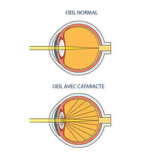 vision cataracte yeux cause chirurgien ophtalmologue paupieres paris docteur florence pouget theron paris